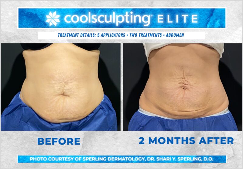 Before & After Abdomen CoolSculpting in New Jersey