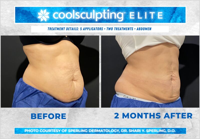 Before & After Abdomen CoolSculpting in New Jersey