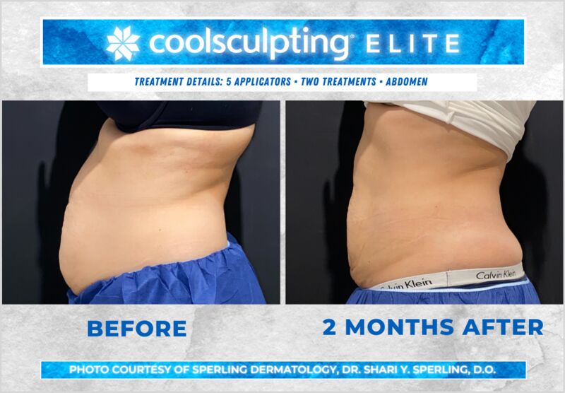 Before & After Abdomen CoolSculpting in New Jersey