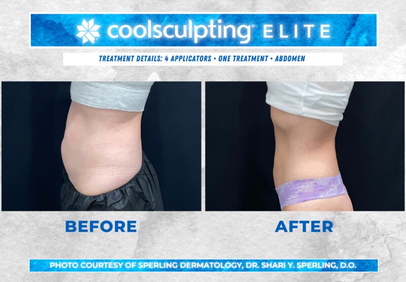 Before & After Abdomen CoolSculpting in New Jersey