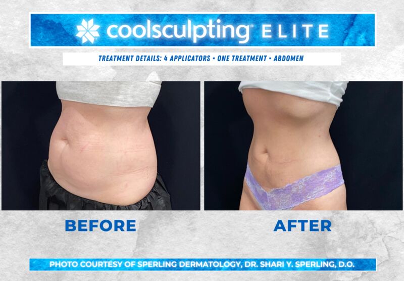Before & After Abdomen CoolSculpting in New Jersey