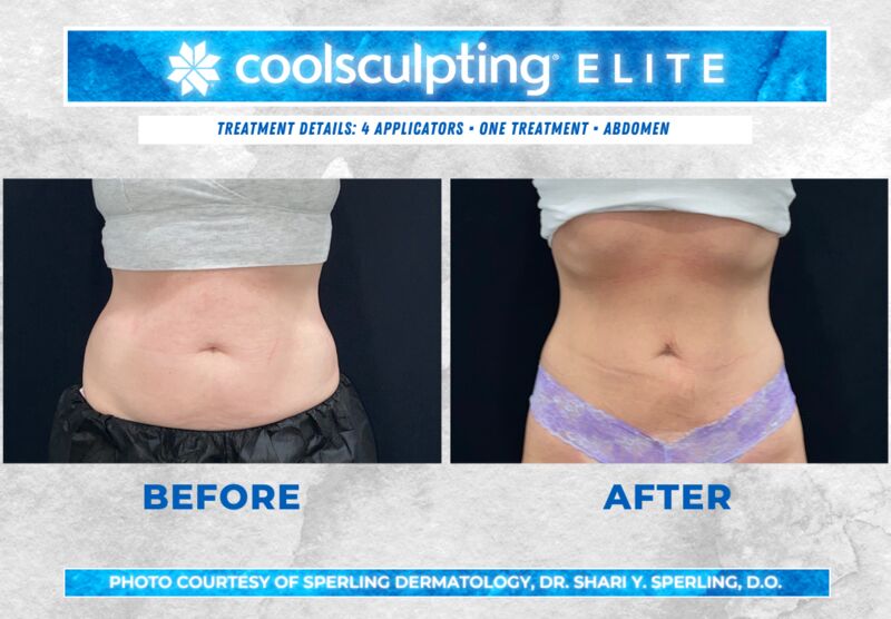 Before & After Abdomen CoolSculpting in New Jersey