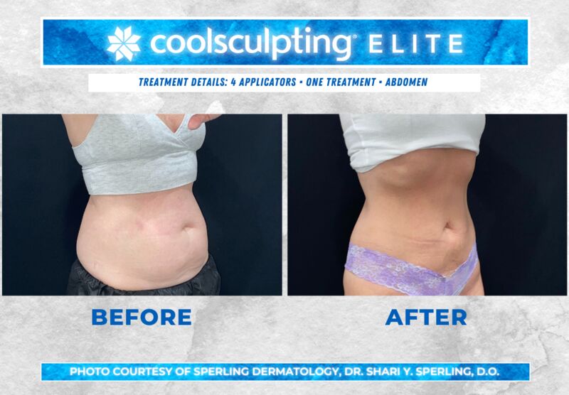 Before & After Abdomen CoolSculpting in New Jersey