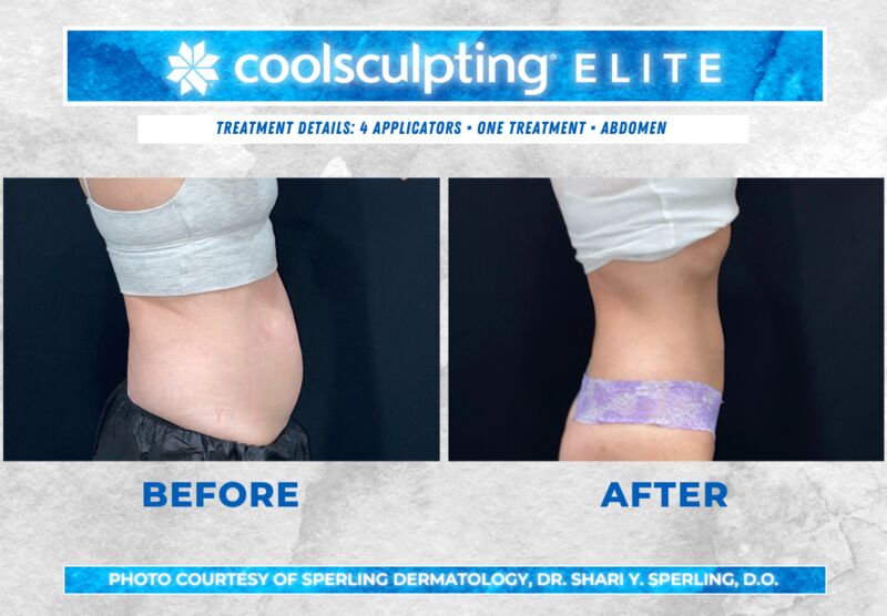 Before & After Abdomen CoolSculpting in New Jersey