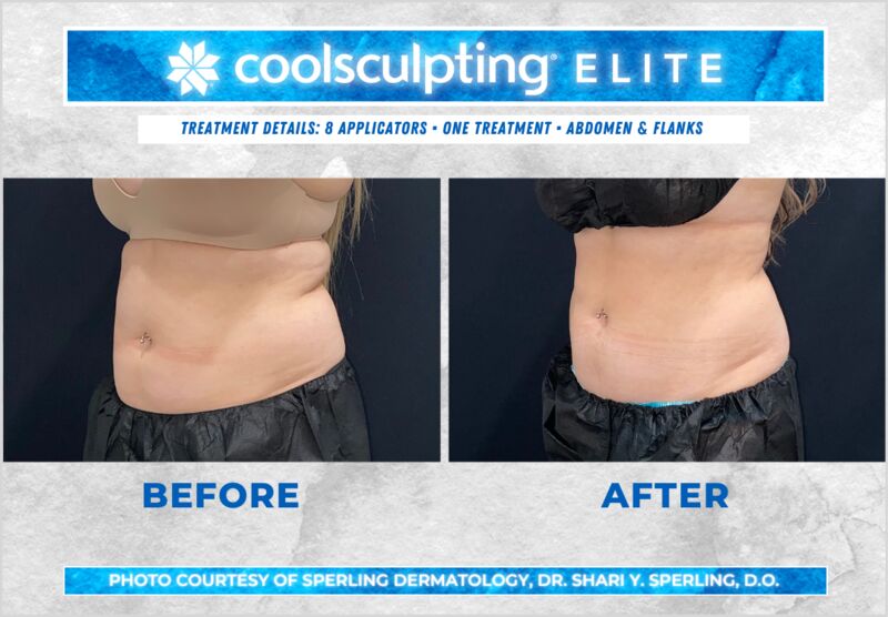 Before & After Abdomen CoolSculpting in New Jersey