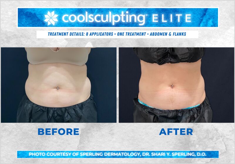 Before & After Abdomen CoolSculpting in New Jersey