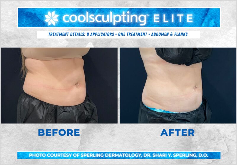 Before & After Abdomen CoolSculpting in New Jersey