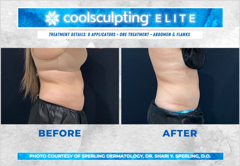 Before & After Abdomen CoolSculpting in New Jersey