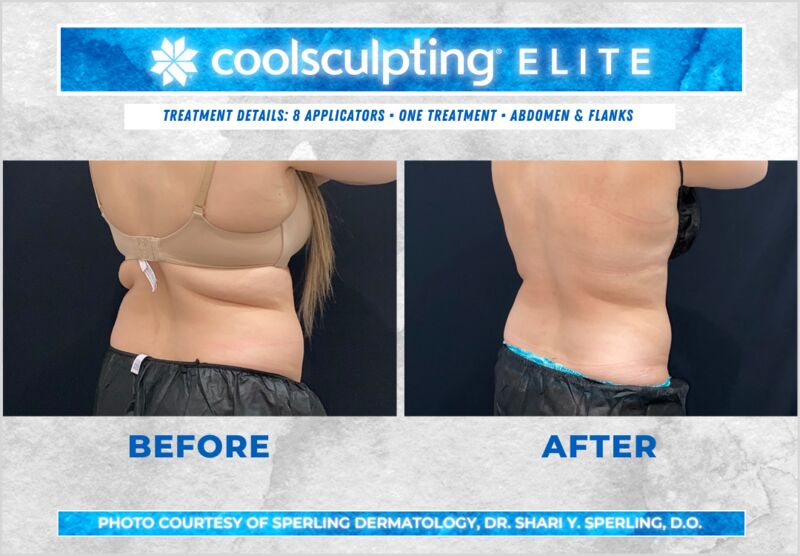 Before & After Abdomen CoolSculpting in New Jersey