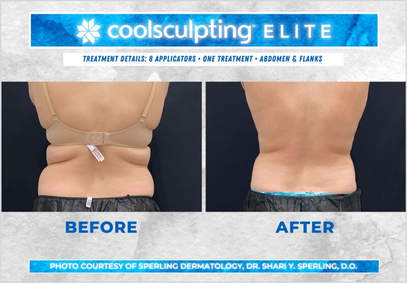 Before & After Abdomen CoolSculpting in New Jersey