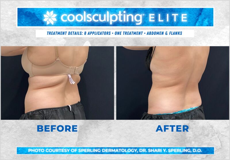 Before & After Abdomen CoolSculpting in New Jersey