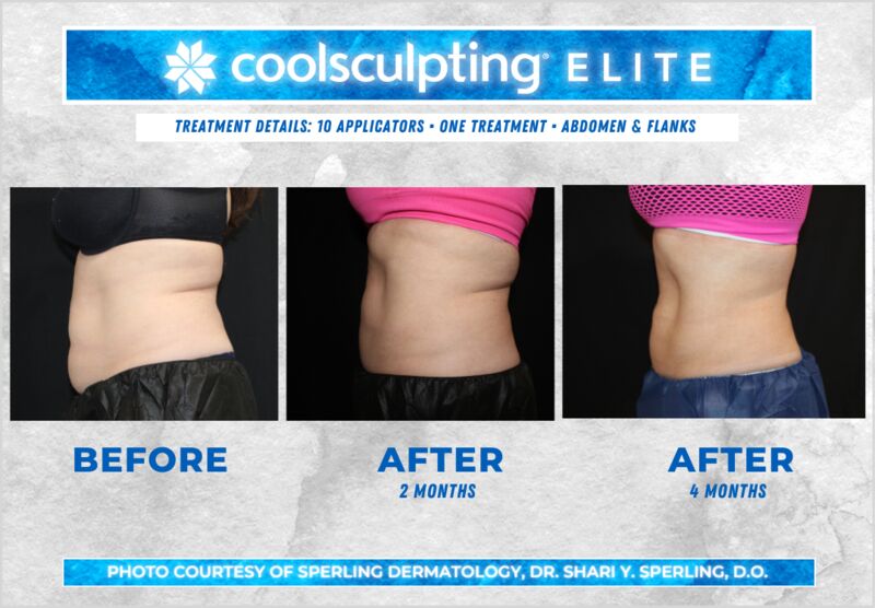 Before & After Abdomen CoolSculpting in New Jersey