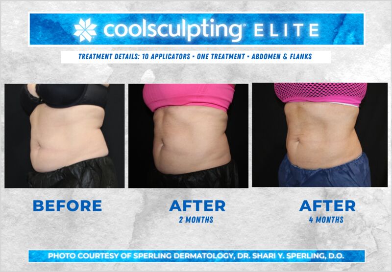 Before & After Abdomen CoolSculpting in New Jersey