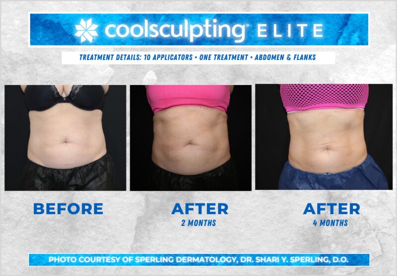 Before & After Abdomen CoolSculpting in New Jersey