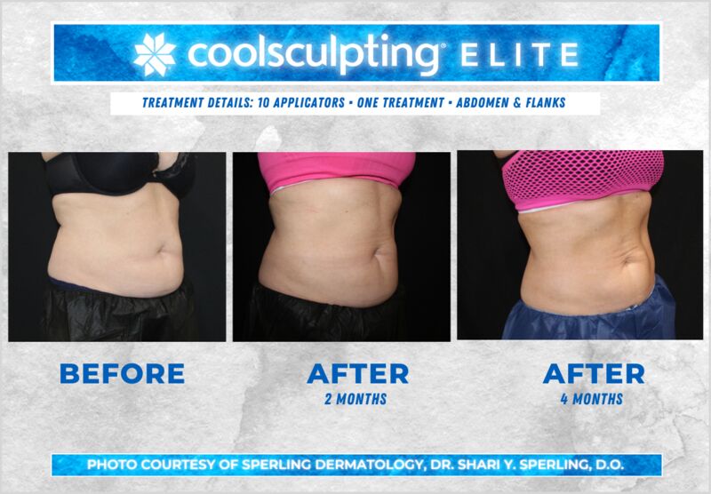 Before & After Abdomen CoolSculpting in New Jersey