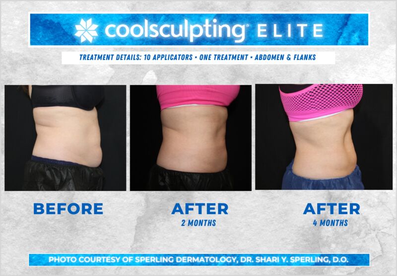 Before & After Abdomen CoolSculpting in New Jersey