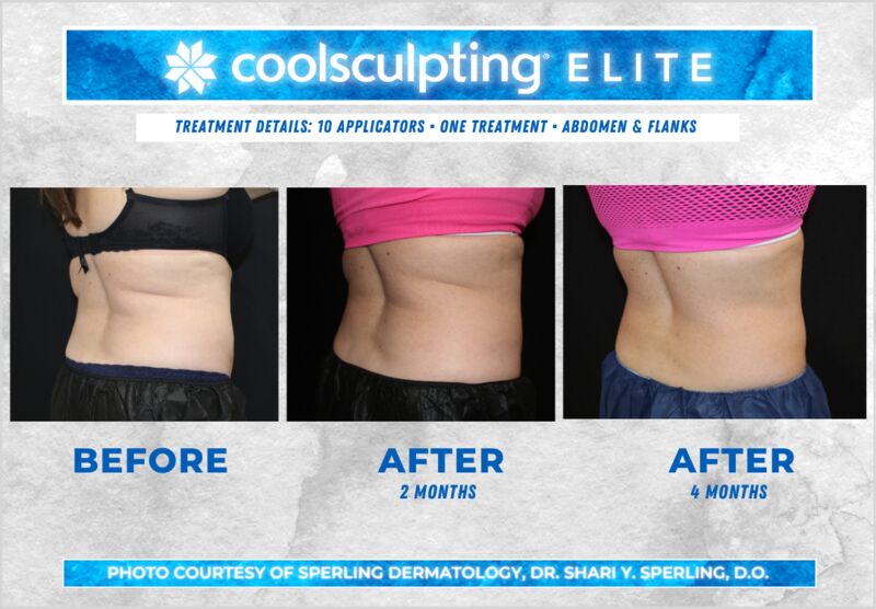 Before & After Abdomen CoolSculpting in New Jersey