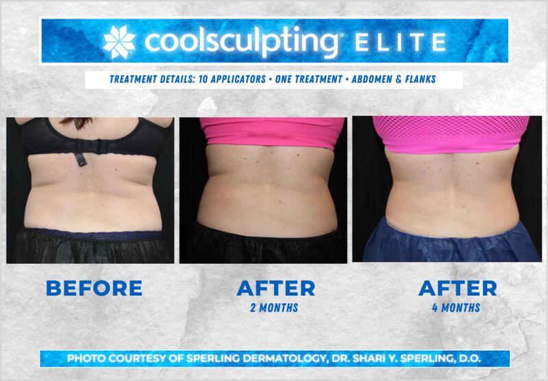 Before & After Abdomen CoolSculpting in New Jersey