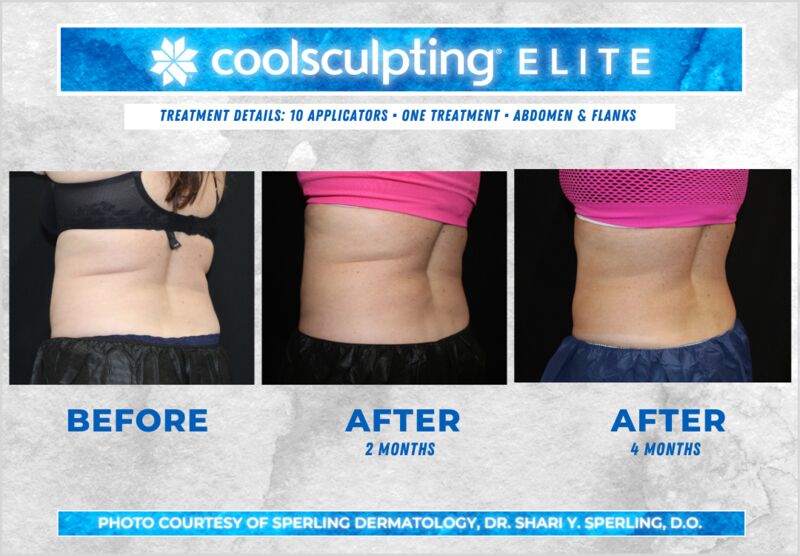 Before & After Abdomen CoolSculpting in New Jersey