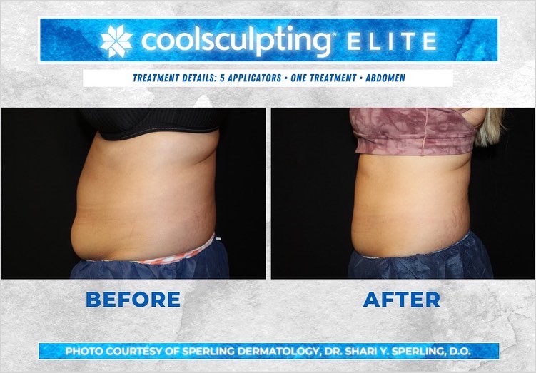 Before & After Abdomen CoolSculpting in New Jersey