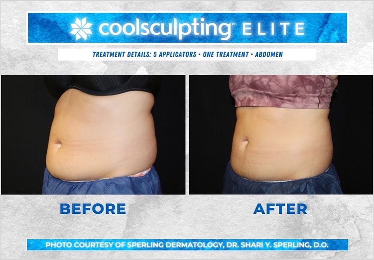 Before & After Abdomen CoolSculpting in New Jersey