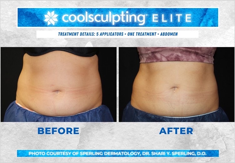 Before & After Abdomen CoolSculpting in New Jersey