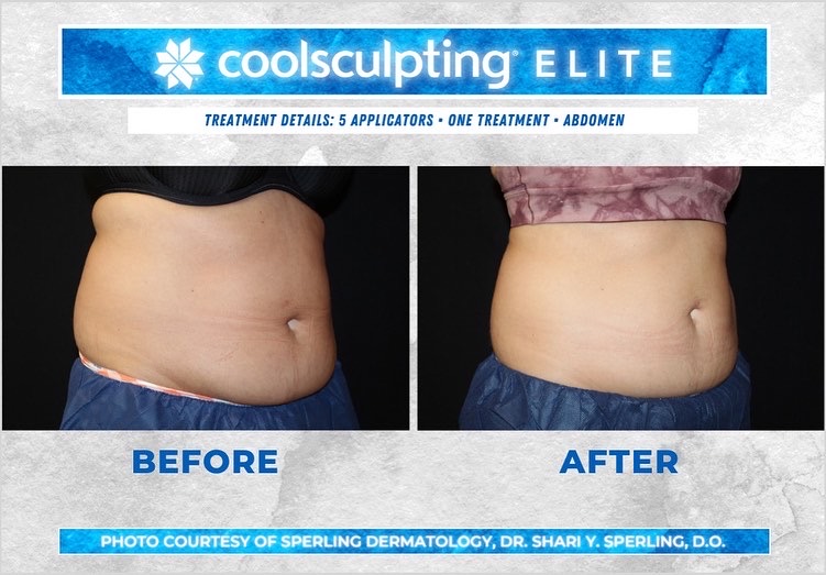 Before & After Abdomen CoolSculpting in New Jersey