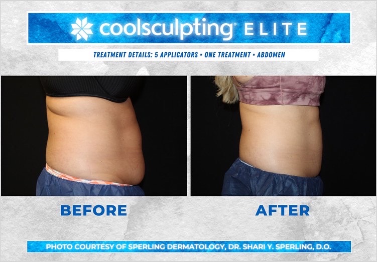 Before & After Abdomen CoolSculpting in New Jersey