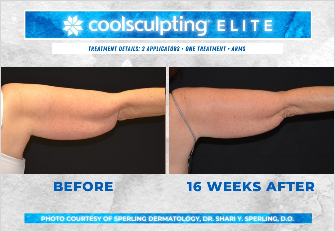 Before & After Arms CoolSculpting in New Jersey