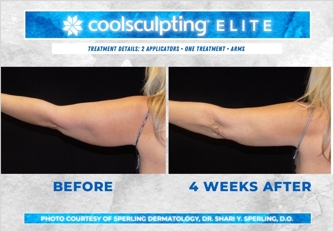 Before & After Arms CoolSculpting in New Jersey