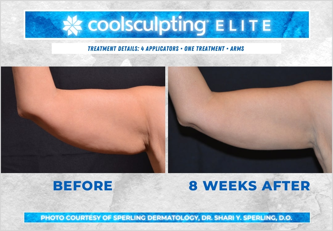 Before & After Arms CoolSculpting in New Jersey