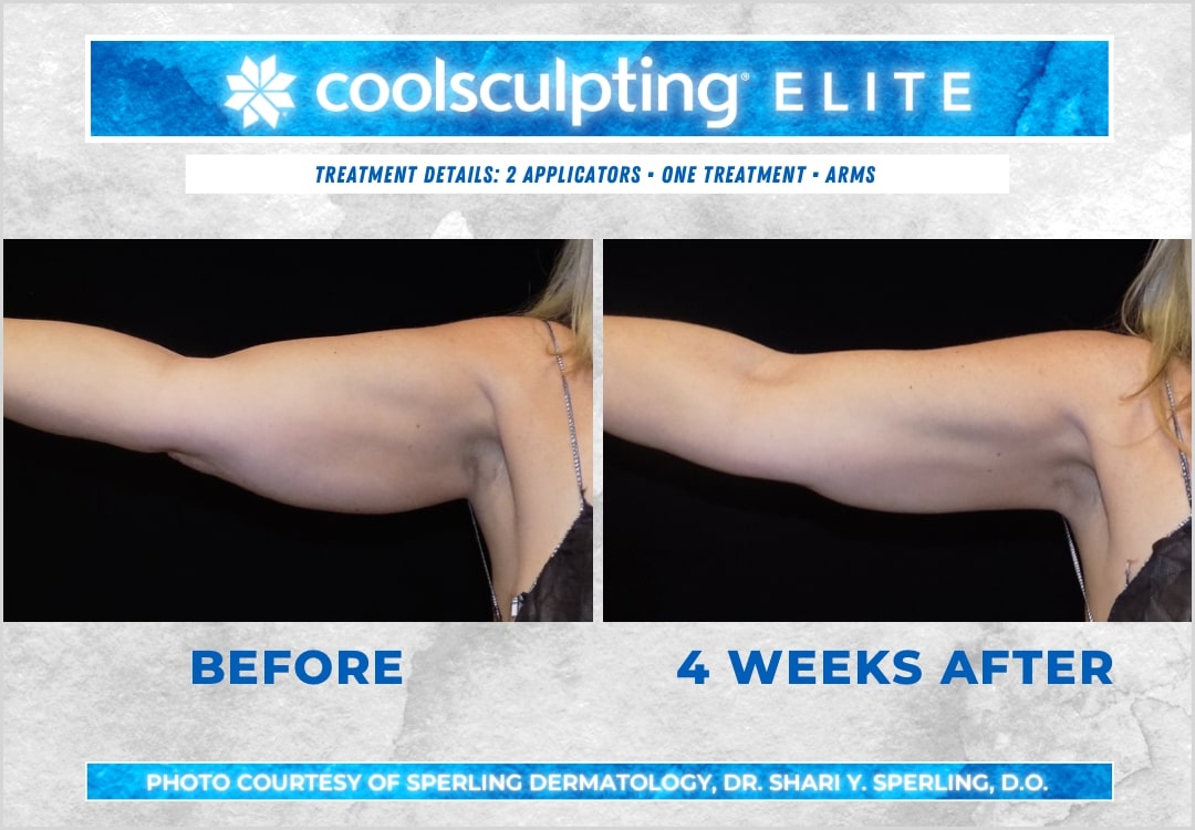 Before & After Arms CoolSculpting in New Jersey