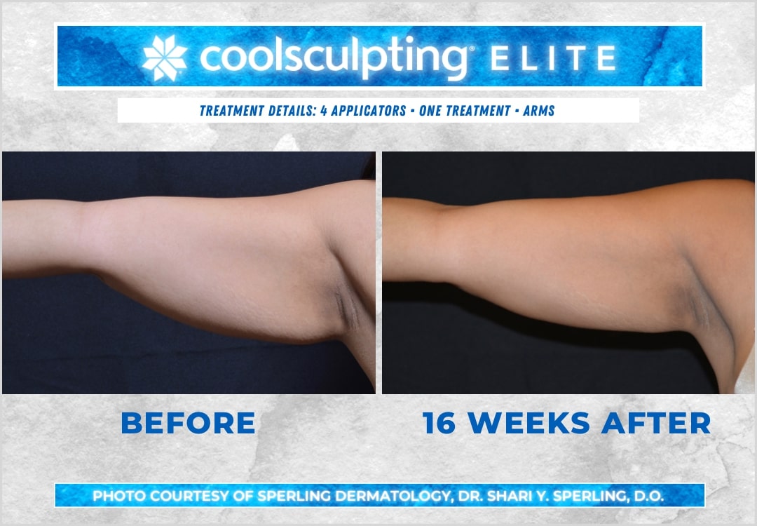 Before & After Arms CoolSculpting in New Jersey