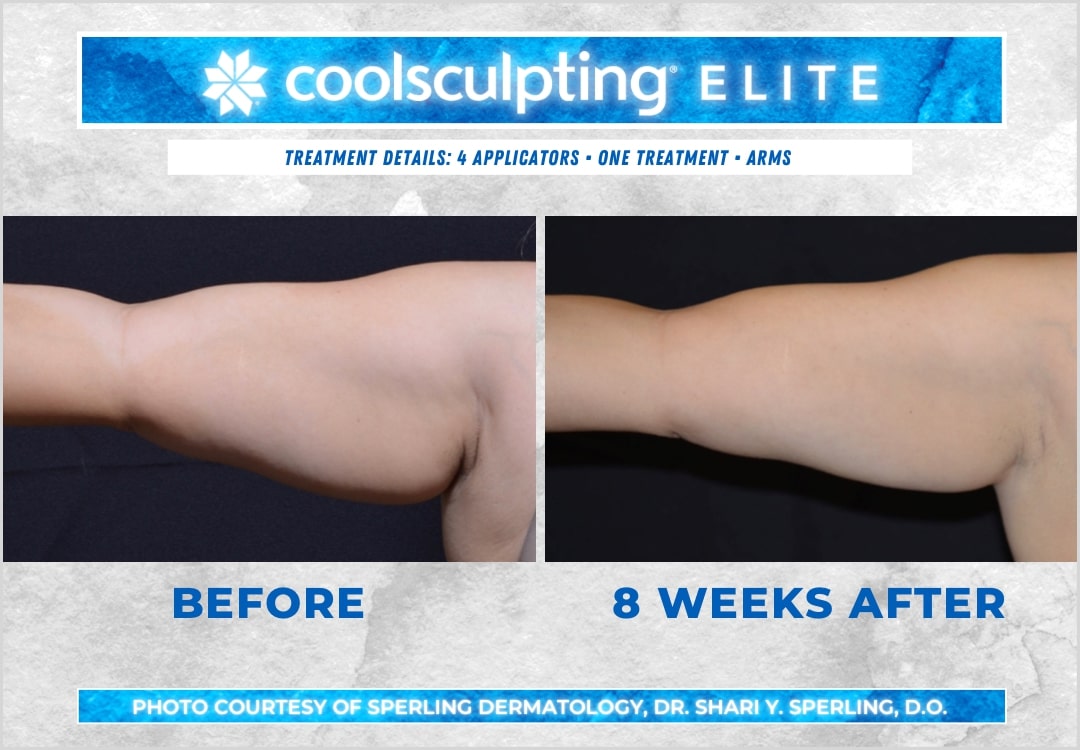 Before & After Arms CoolSculpting in New Jersey