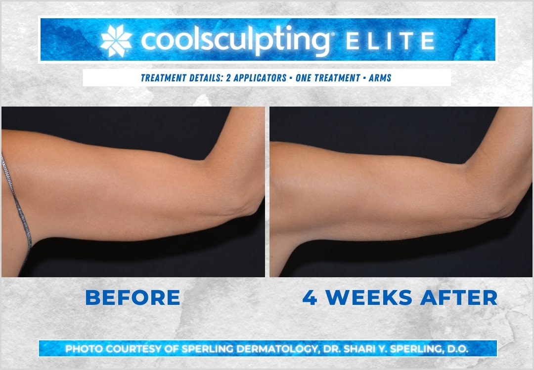 Before & After Arms CoolSculpting in New Jersey