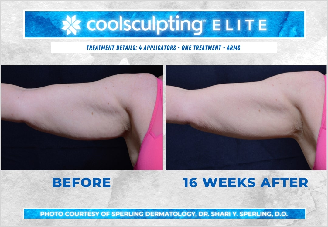 Before & After Arms CoolSculpting in New Jersey