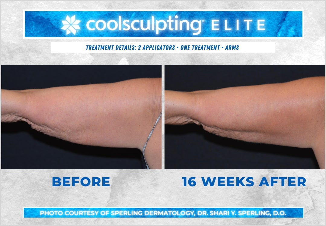 Before & After Arms CoolSculpting in New Jersey