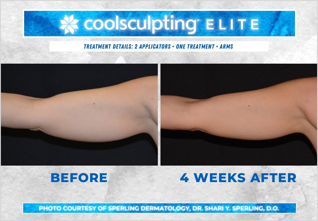 Before & After Arms CoolSculpting in New Jersey