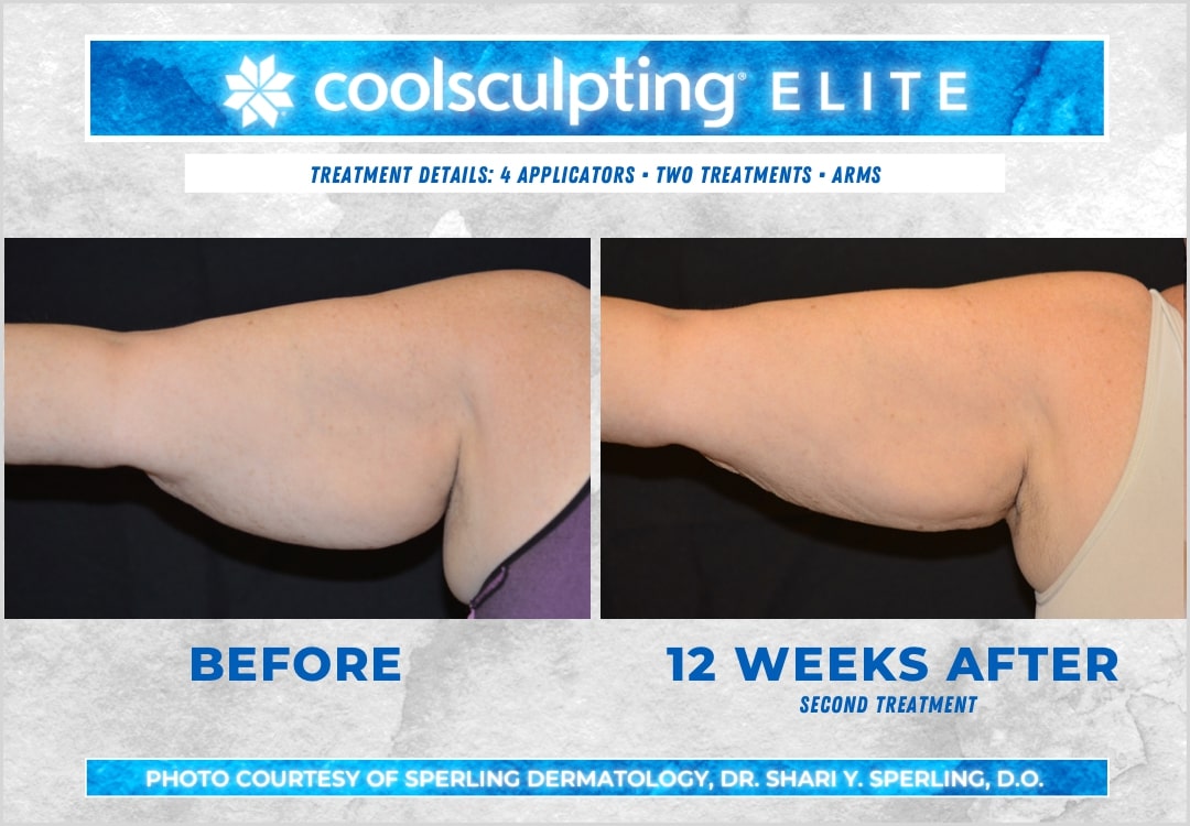 Before & After Arms CoolSculpting in New Jersey