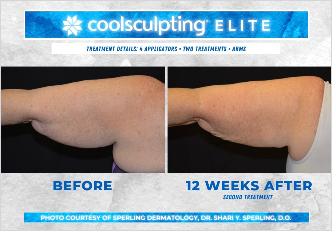 Before & After Arms CoolSculpting in New Jersey