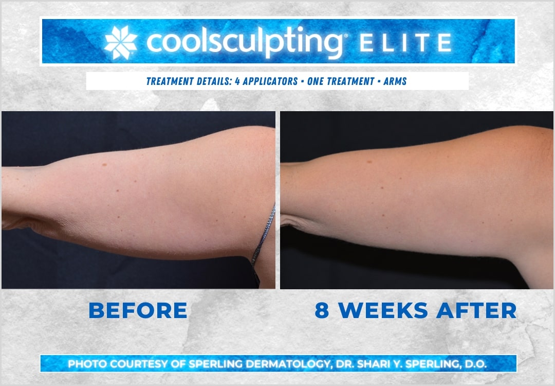 Before & After Arms CoolSculpting in New Jersey