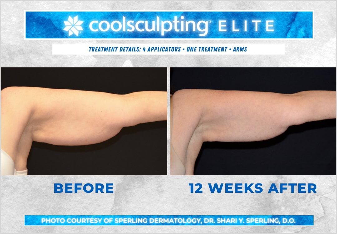 Before & After Arms CoolSculpting in New Jersey