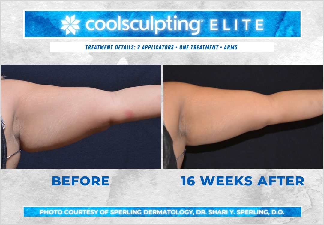 Before & After Arms CoolSculpting in New Jersey