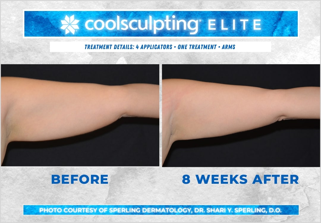 Before & After Arms CoolSculpting in New Jersey