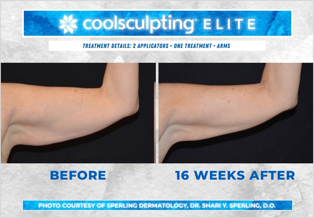 Before & After Arms CoolSculpting in New Jersey