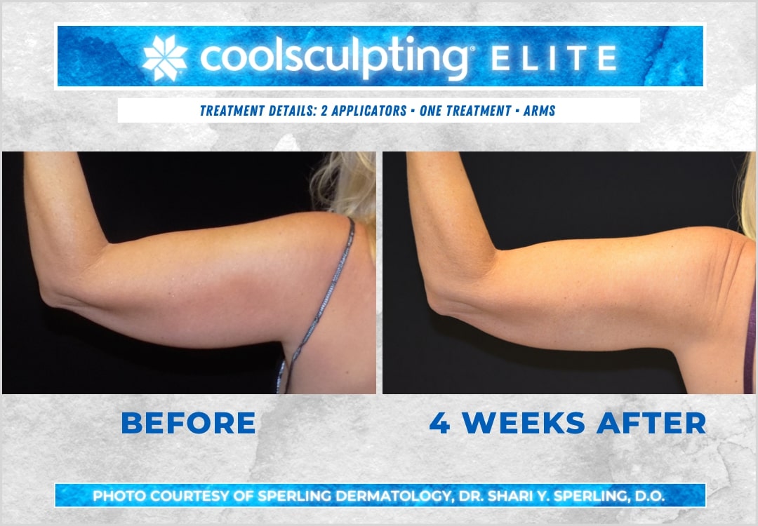 Before & After Arms CoolSculpting in New Jersey