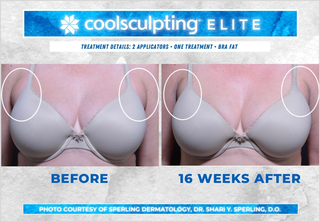 Before & After Axillary Puffs CoolSculpting in New Jersey