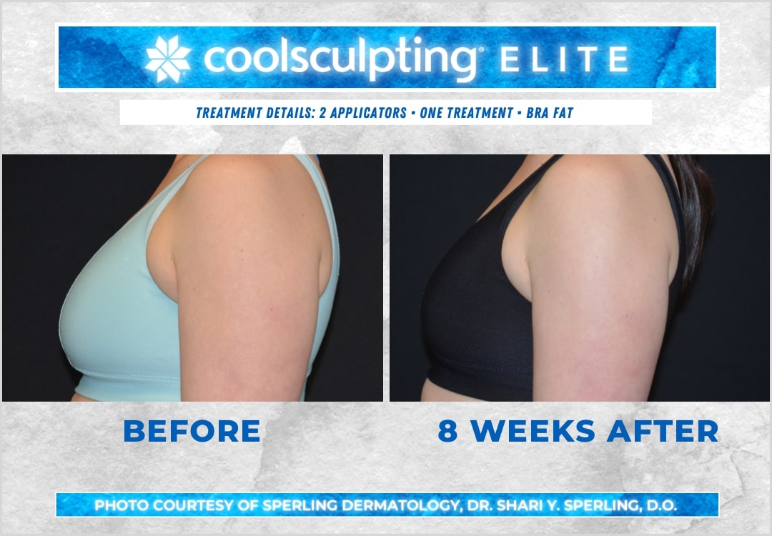 Before & After Axillary Puffs CoolSculpting in New Jersey