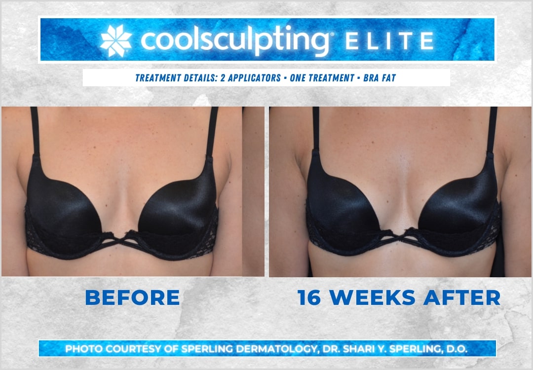 Before & After Axillary Puffs CoolSculpting in New Jersey