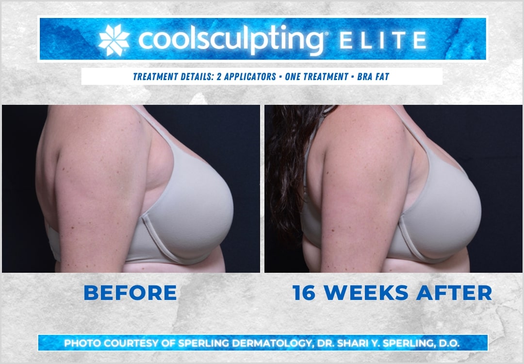 Before & After Axillary Puffs CoolSculpting in New Jersey